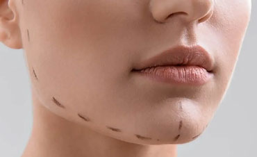 مقایسه پروتز چانه و تزریق ژل چانه