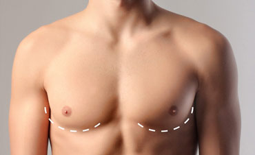 آمادگی برای جراحی کوچک کردن سینه مردان