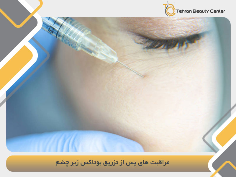 مراقبت های پس از تزریق بوتاکس زیر چشم