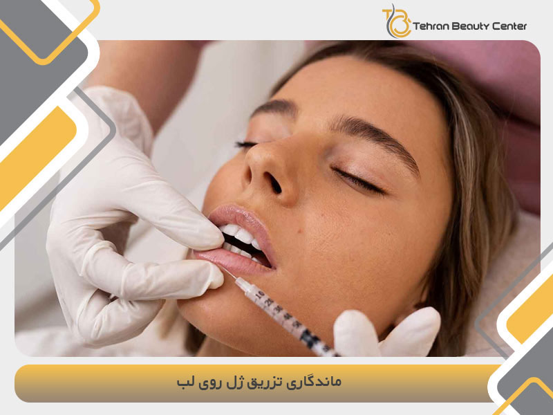 ماندگاری تزریق ژل روی لب