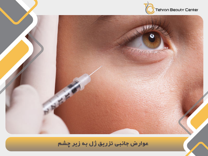 عوارض جانبی تزریق ژل به زیر چشم