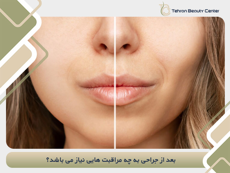 بعد از جراحی به چه مراقبت هایی نیاز می باشد؟