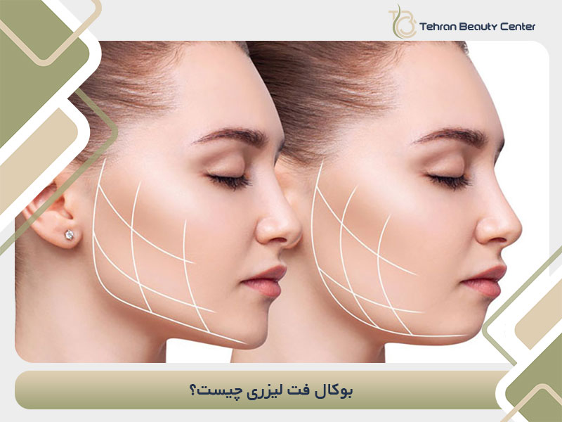 بوکال فت لیزری چیست؟