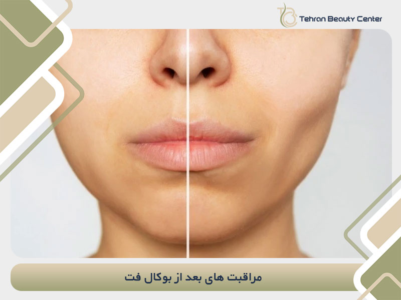 مراقبت های بعد از بوکال فت