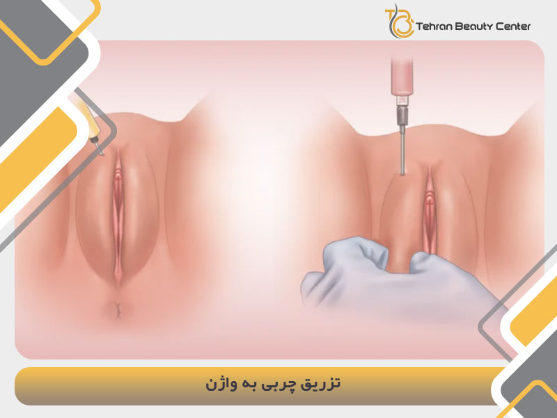 تزریق چربی به واژن