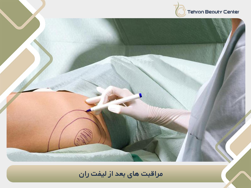 مراقبت های پس از جراحی لیفت ران