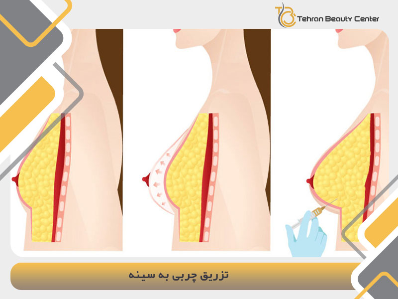 تزریق چربی به سینه