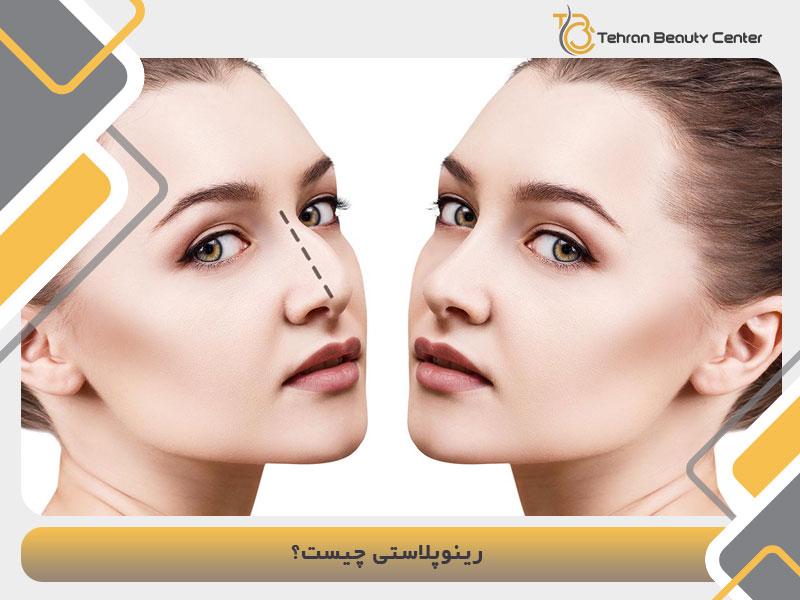 رینوپلاستی چیست؟