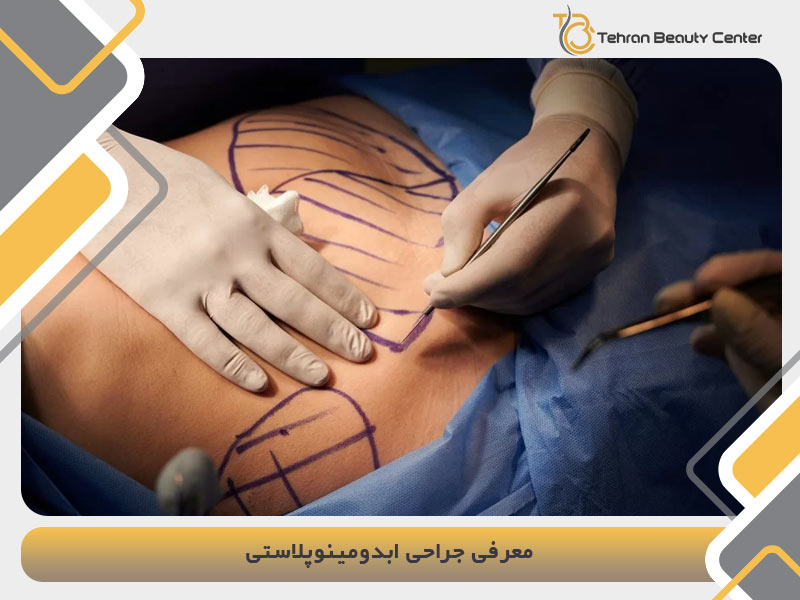 معرفی روش ابدومینوپلاستی