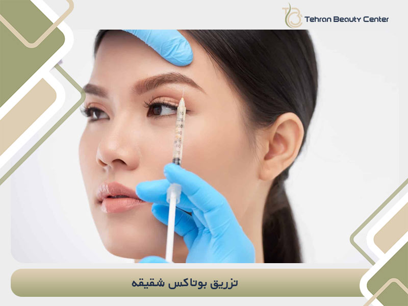 تزریق بوتاکس شقیقه