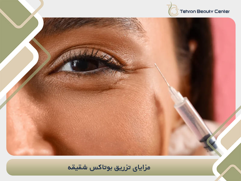 مزایای تزریق بوتاکس شقیقه