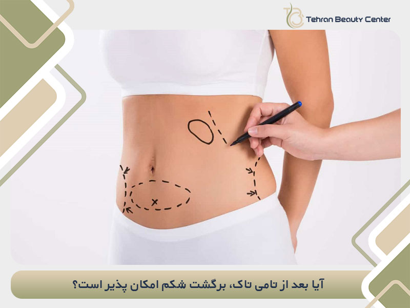 آیا بعد از تامی تاک، برگشت شکم امکان پذیر است؟