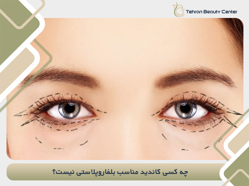 چه کسی کاندید مناسب بلفاروپلاستی نیست؟