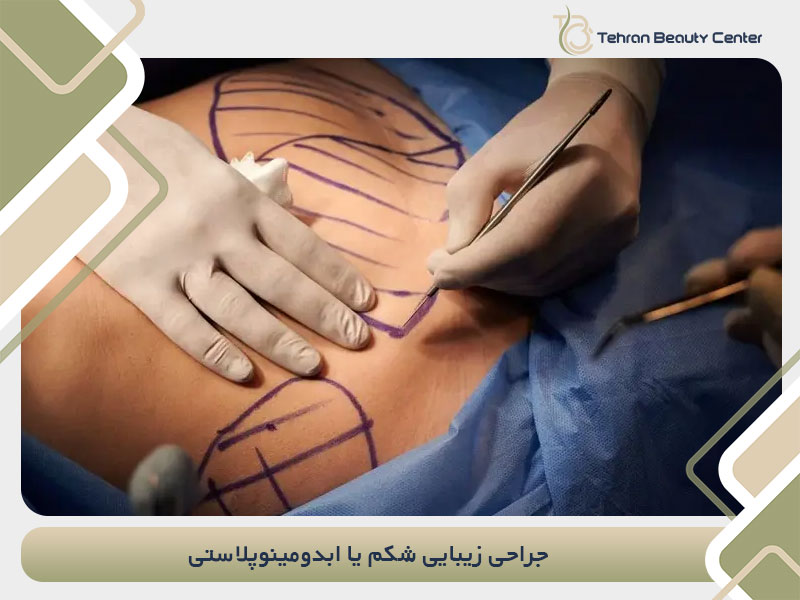 جراحی زیبایی شکم یا ابدومینوپلاستی