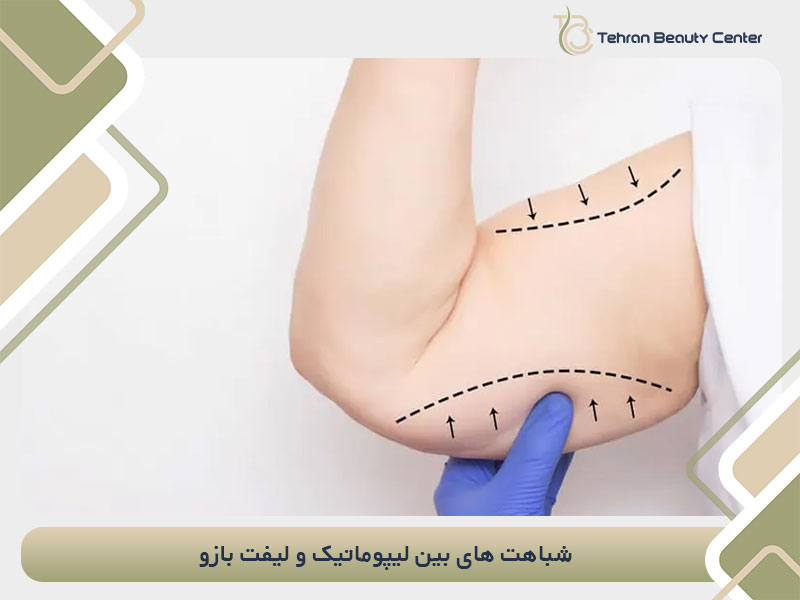 شباهت های بین لیپوماتیک و لیفت بازو