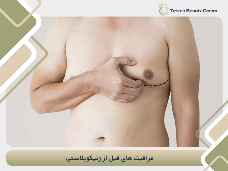 مراقبت های قبل از ژنیکوپلاستی