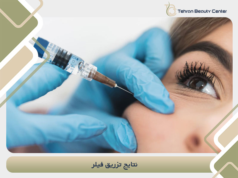نتایج تزریق فیلر