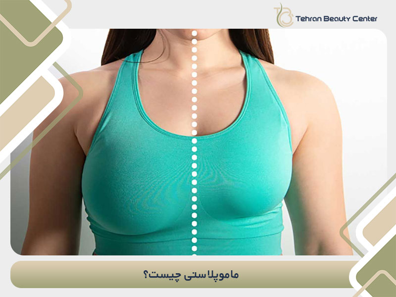 ماموپلاستی چیست؟