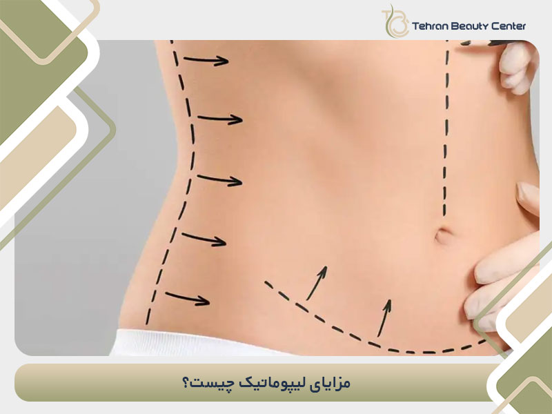 مزایای لیپوماتیک چیست؟