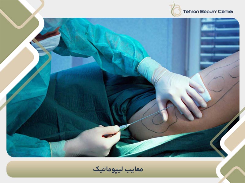 معایب لیپوماتیک