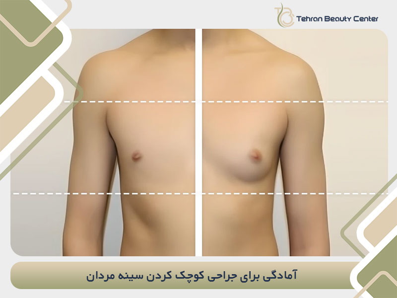 آمادگی برای جراحی کوچک کردن سینه مردان