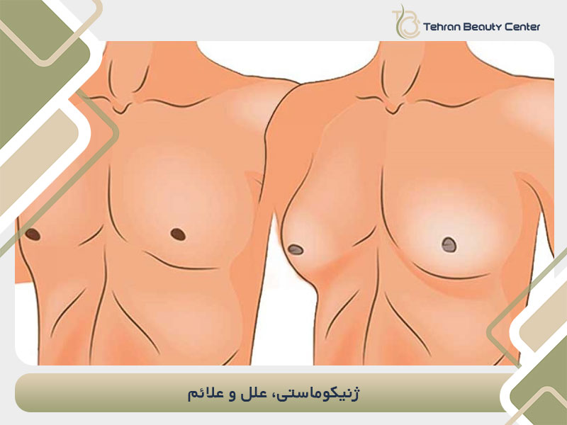ژنیکوماستی، علل و علائم