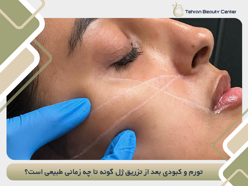 تورم و کبودی بعد از تزریق ژل گونه تا چه زمانی طبیعی است؟