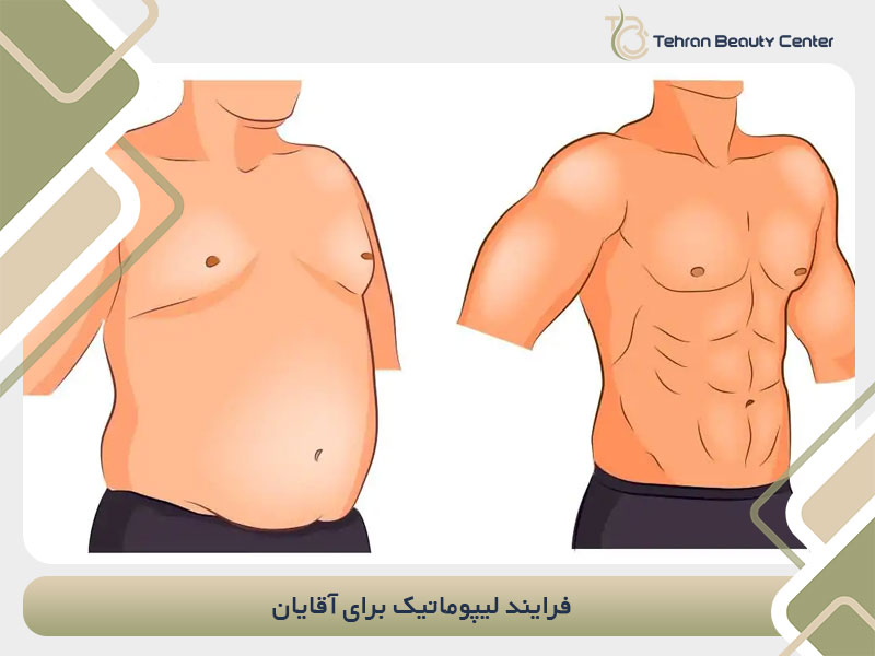 فرایند لیپوماتیک برای آقایان