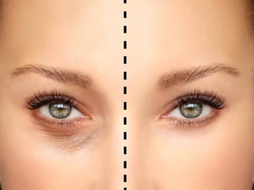 تصاویر نمونه کار بلفاروپلاستی