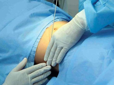 تصاویر نمونه کار لیپوماتیک