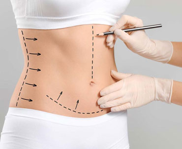 ابدومینوپلاستی