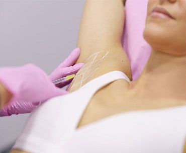 تزریق بوتاکس زیر بغل