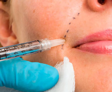 تزریق ژل به خط لبخند و اخم