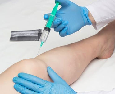 تزریق ژل به زانو