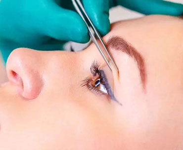 بلفاروپلاستی