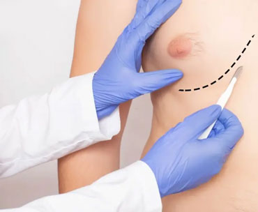 ژنیکوپلاستی