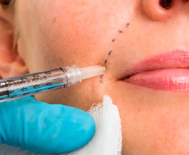 تزریق بوتاکس خط خنده